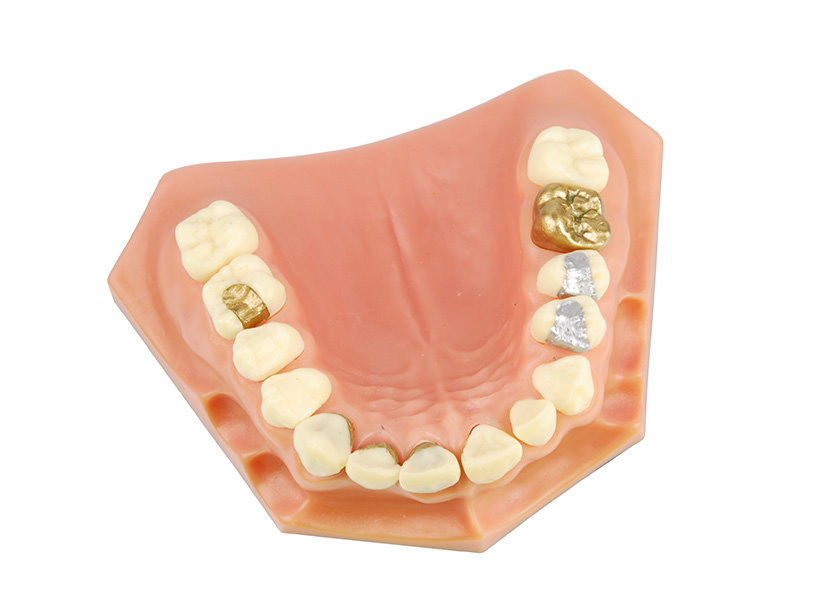 cost of a dental crown in delhi