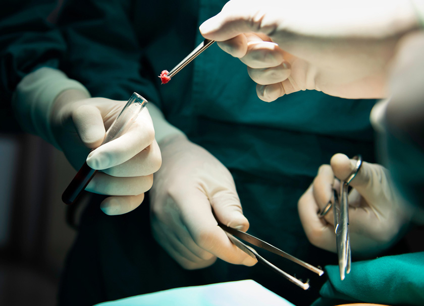 Biopsy