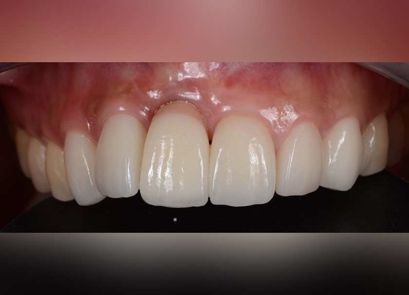 Gum Veneers