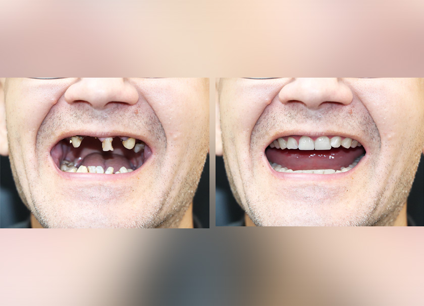Implant Prosthetics