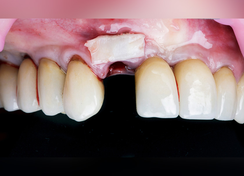 Periodontal Augmentation