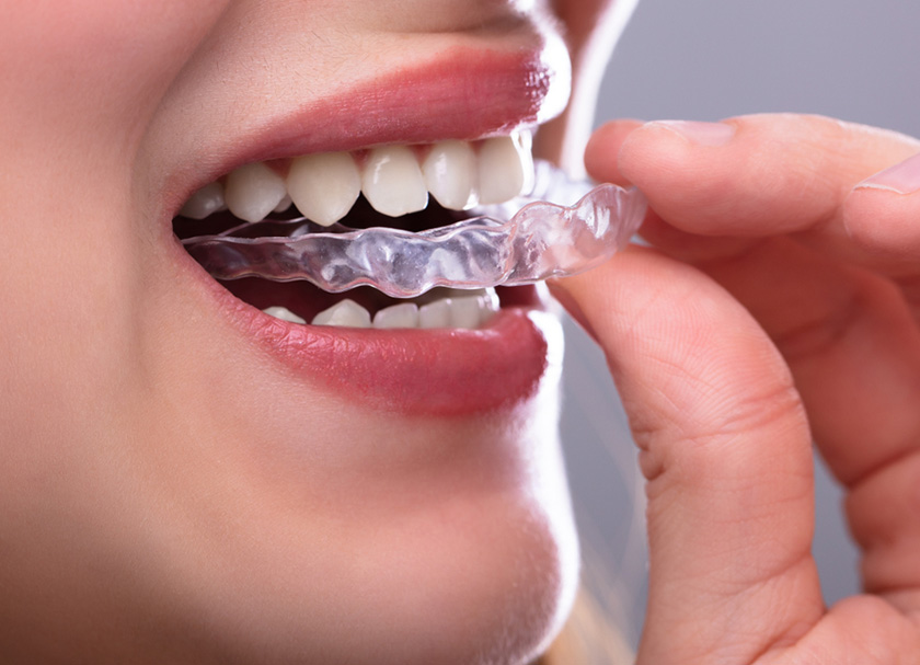 Custom Fitted Mouthguards