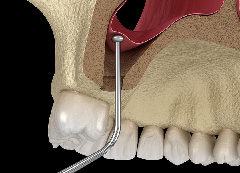 Sinus Lift Surgery