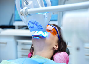 What Is Tooth Whitening or Bleaching?